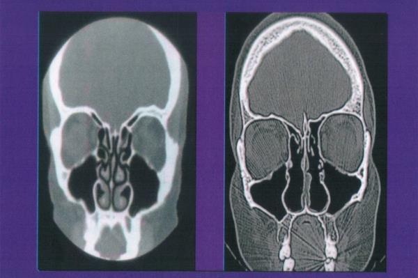 ENS is a complication of any nasal surgery that affects the turbinates —  cylindrical structures in the nose that regulate incoming air. Turbinate reduction is sometimes an add-on to septoplasty for a deviated septum, or even a regular nose job. 